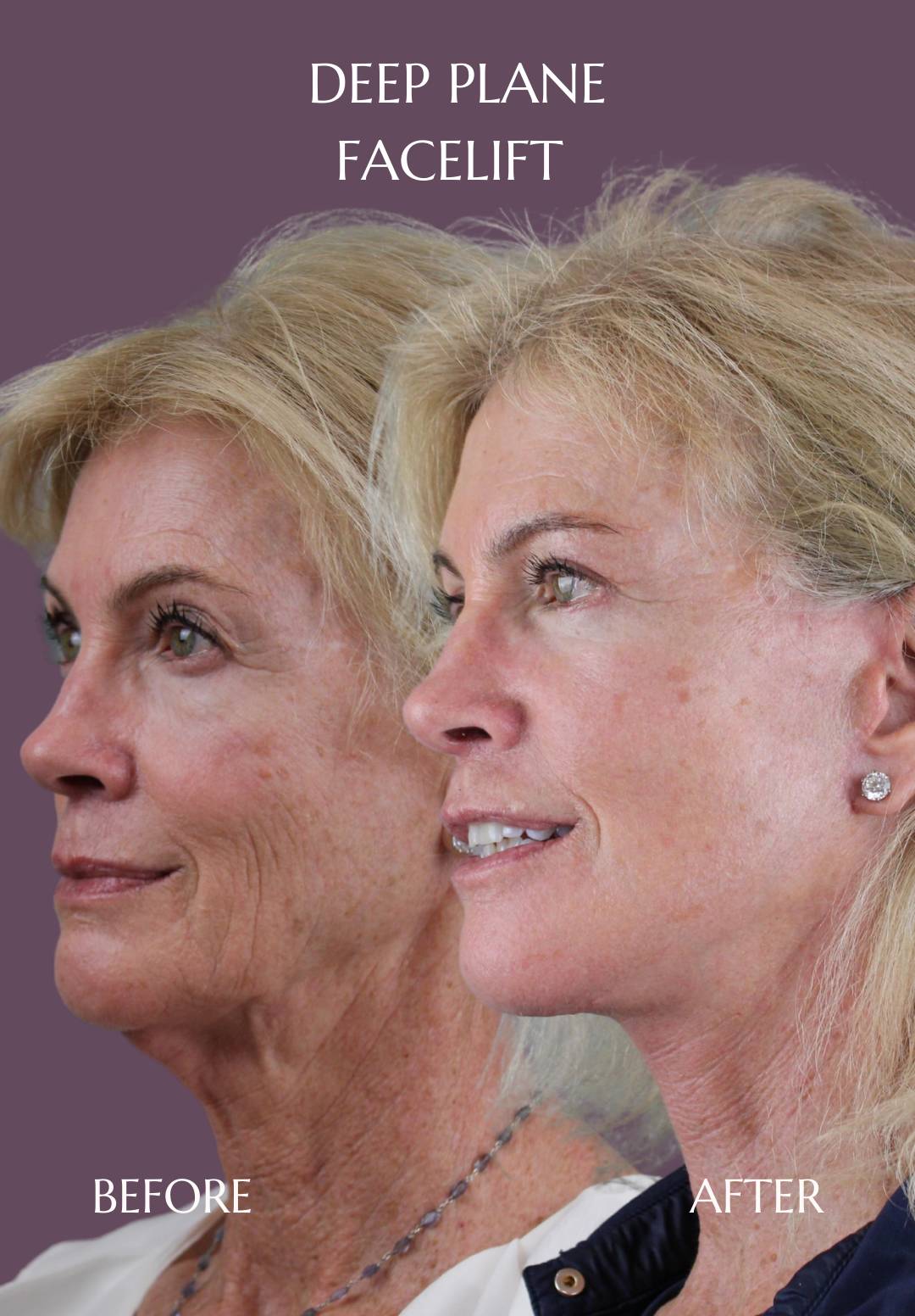 Dr. Mara explains the placement of the incisions and the deep-plane technique in a deep-plane facelift, including SMAS repositioning and additional facial procedures Dr. Mara – Before-and-After Results