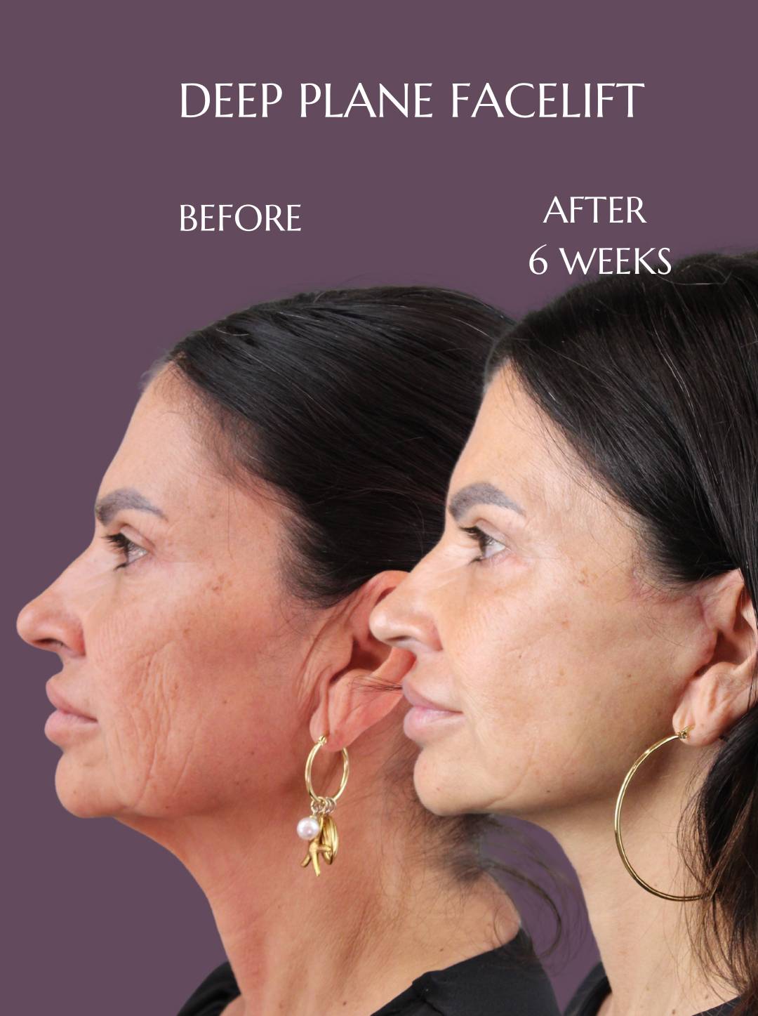 Dr. Mara explains the placement of the incisions and the deep-plane technique in a deep-plane facelift, including SMAS repositioning and additional facial procedures Dr. Mara – Before & After Results