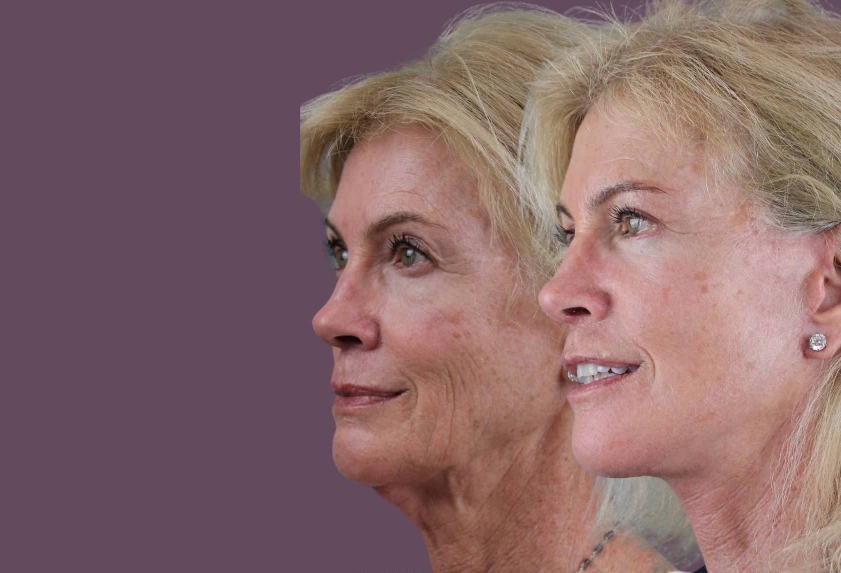 Dr. Mariana Ostrerova stands for natural facelift results that preserve facial expressions.