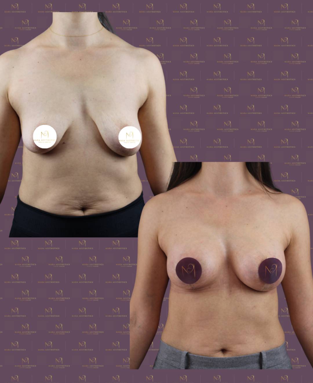 Vorher-Nachher-Vergleich einer Bruststraffung und Brustvergrößerung bei Mara Aesthetics auf Mallorca.