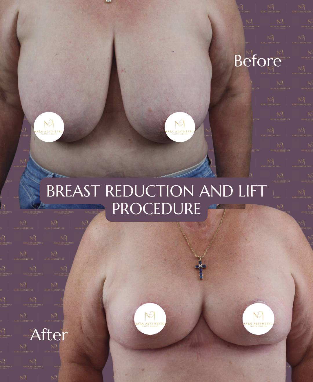 Vorher-Nachher-Vergleich Brustverkleinerung und Bruststraffung bei Mara Aesthetics auf Mallorca.